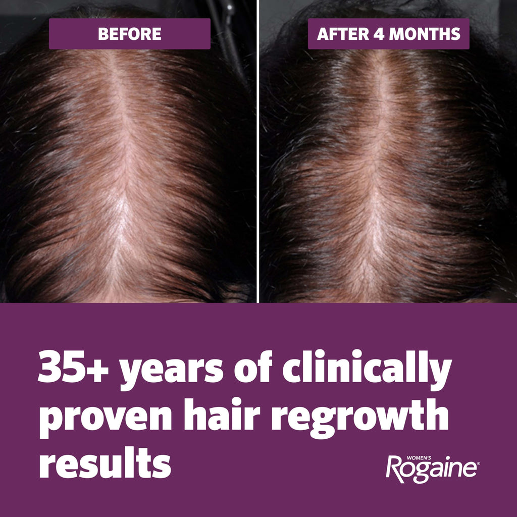 Women's Rogaine 5% Minoxidil Topical Foam, Unscented, 2 x 2.11 oz | Once-a-Day Hair Loss Treatment for Women, Regrow Fuller, Thicker Hair, Unscented, 4-Month Supply