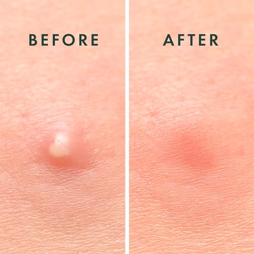 Rael Miracle Invisible Spot Cover Hydrocolloid Acne Pimple Patches (96 Ct) | Ultra-Thin Patch for Face, Absorbs Fluid From Blemishes, Facial Sticker, Korean Skin Care, Pore Care, 2 Sizes